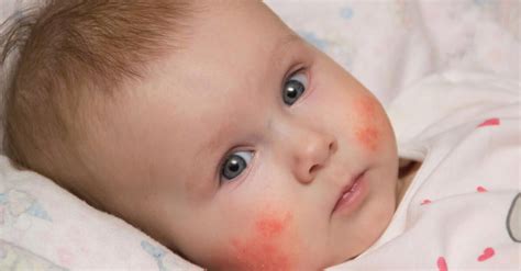 Bebeklerde Alerji Belirtileri ve Tedavi Yöntemleri