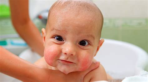 Bebeğin Alerjik Cilt Problemleri İçin Doğal Tedavi Yöntemleri